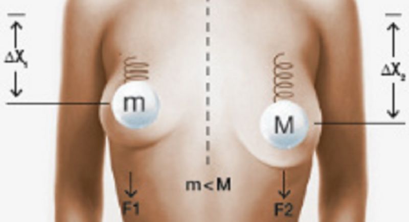 Καινοτόμα ενθέματα αλλάζουν τα δεδομένα στην αποκατάσαση στήθους