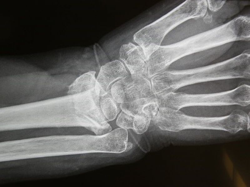 Αρθροπλαστική καρπού αποτρέπει χιλιάδες αναπηρίες