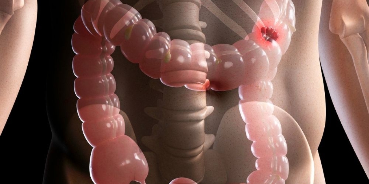 Σύνδρομο Ευερέθιστου Εντέρου και Διατροφή [ΟΔΗΓΟΣ]