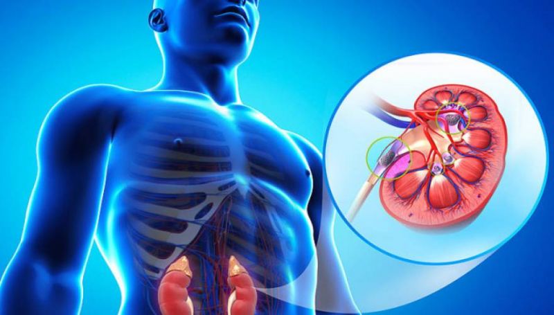 Τα συμπτώματα και πώς θα απαλλαγείτε ανώδυνα από τις πέτρες στα νεφρά