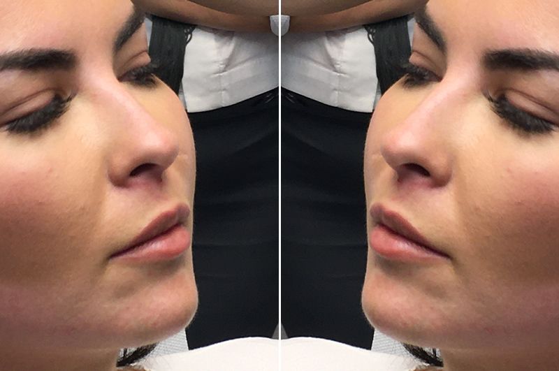 Ποτέ πια αφύσικα φουσκωμένα πρόσωπα και χείλη Ποιες είναι οι νέες εξελίξεις στη βιομηχανία ομορφιάς