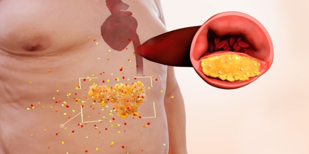 Σπλαχνικό Λίπος: Πως θα το μειώσεις!