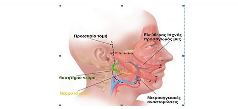Άμεση αποκατάσταση στη χρόνια παράλυση προσώπου δίνει η επανορθωτική πλαστική μικροχειρουργική