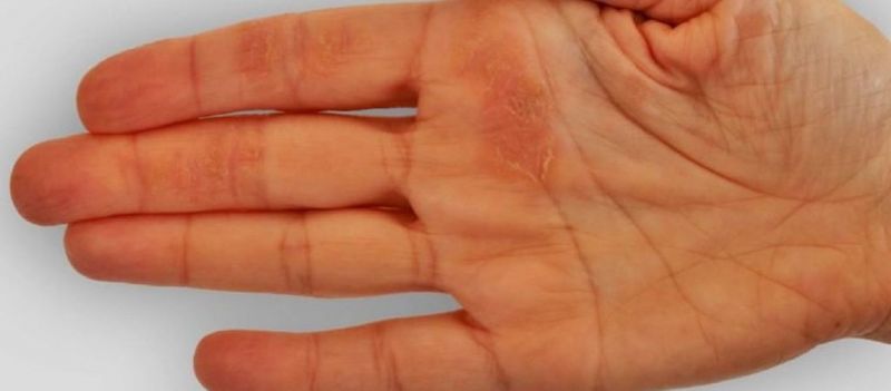 Δείξε μου το χέρι σου να σου πω ποια πάθηση έχεις