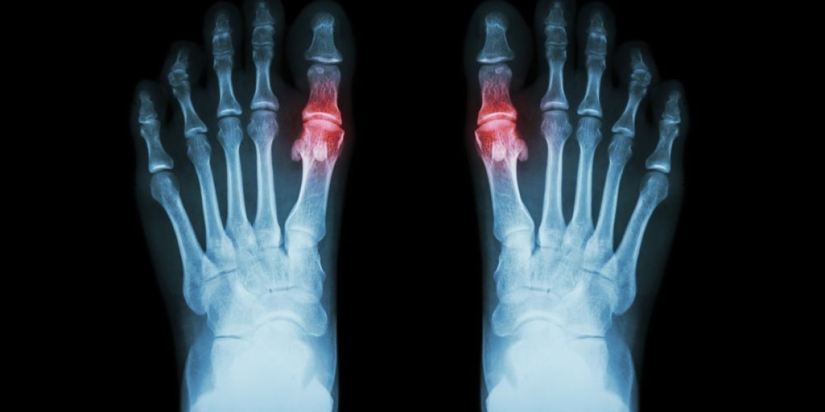 Ουρικό οξύ και Διατροφή [ΟΔΗΓΟΣ]