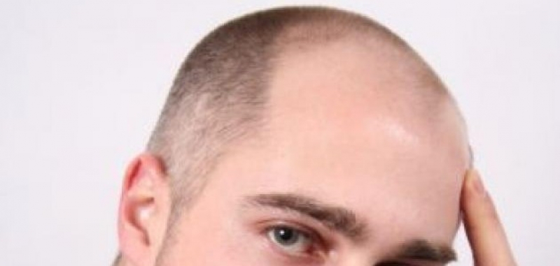 Πως να αποκτήσετε πάλι μαλλιά!