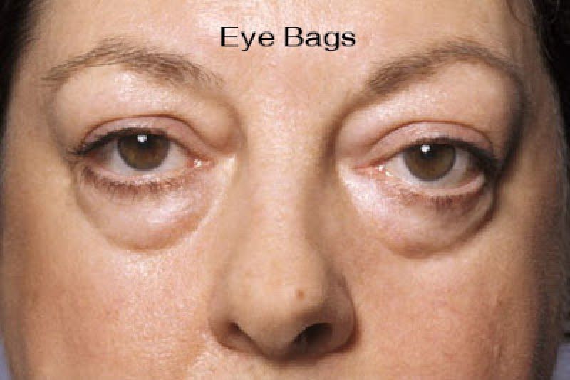 Σακούλες και μαύροι κύκλοι στα μάτια. Που οφείλονται, πρόληψη και φυσικά μέσα για αντιμετώπισή τους