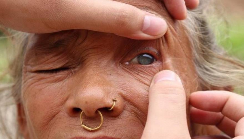 Μέθοδος Νεπάλ για τη θεραπεία του καταρράκτη!