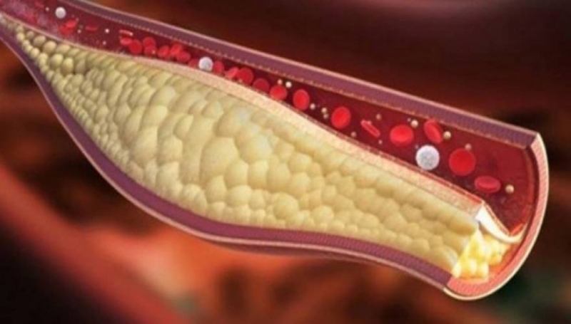 Ξεμπλοκάρετε τις αρτηρίες σας με μόνο ένα ποτήρι από αυτόν τον χυμό!