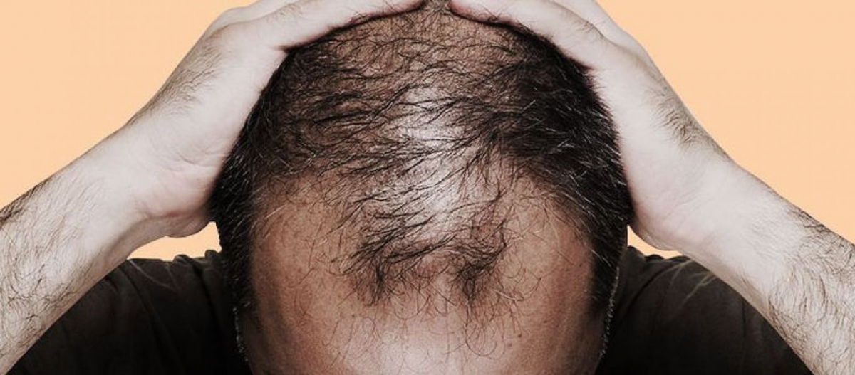 Τριχόπτωση: Έξι τροφές που την καταπολεμούν