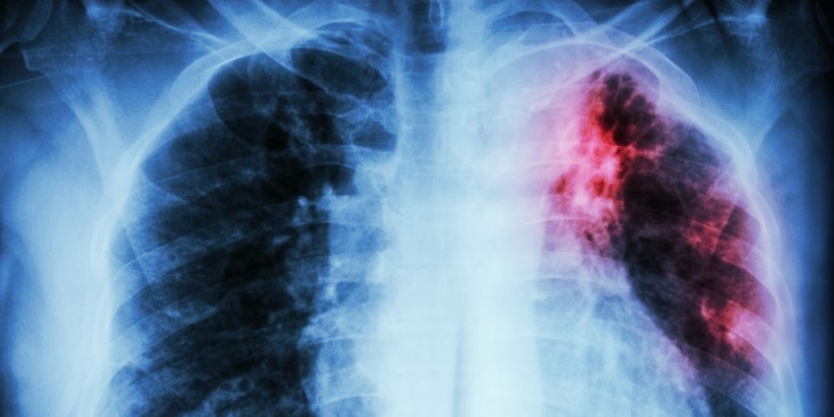 Ιδιοπαθής Πνευμονική Ίνωση (ΙΠΙ)